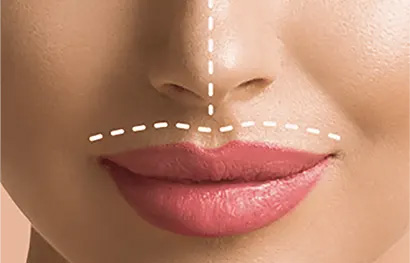 Aumento do Lábio Superior através da Rinoplastia