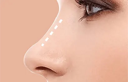 Correção da Perfuração do Septo Nasal