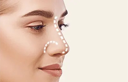 Rinoplastia Secundária/Revisional